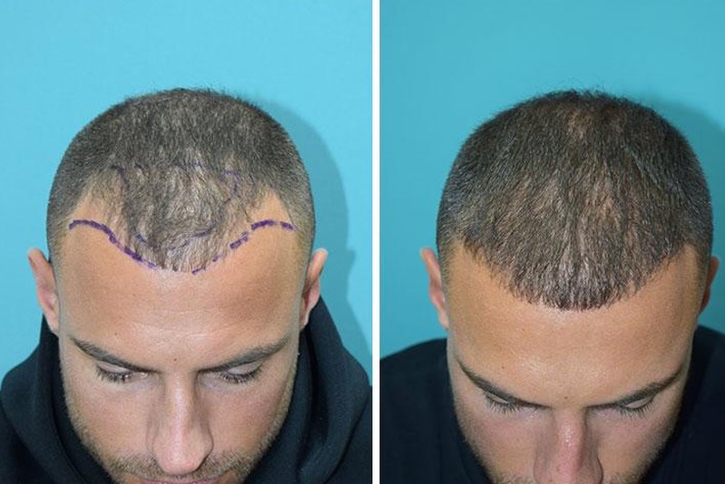 Hair Transplant